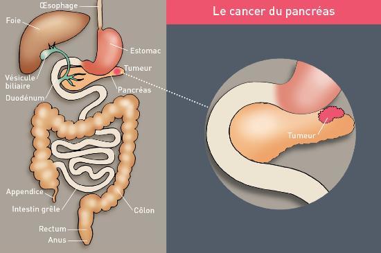 Cancer du pancréas : je m'informe - La cancérologie à l'Hôpital d ...